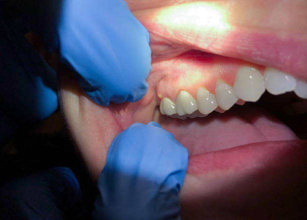 Best Emergency Gum Treatment in Fifth Ward, LA